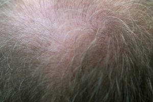 Przeszczep włosów-zabiegi, ceny